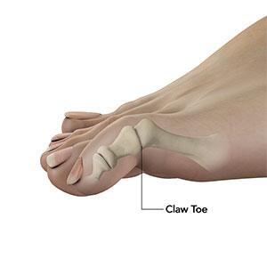 Common Toe Deformities